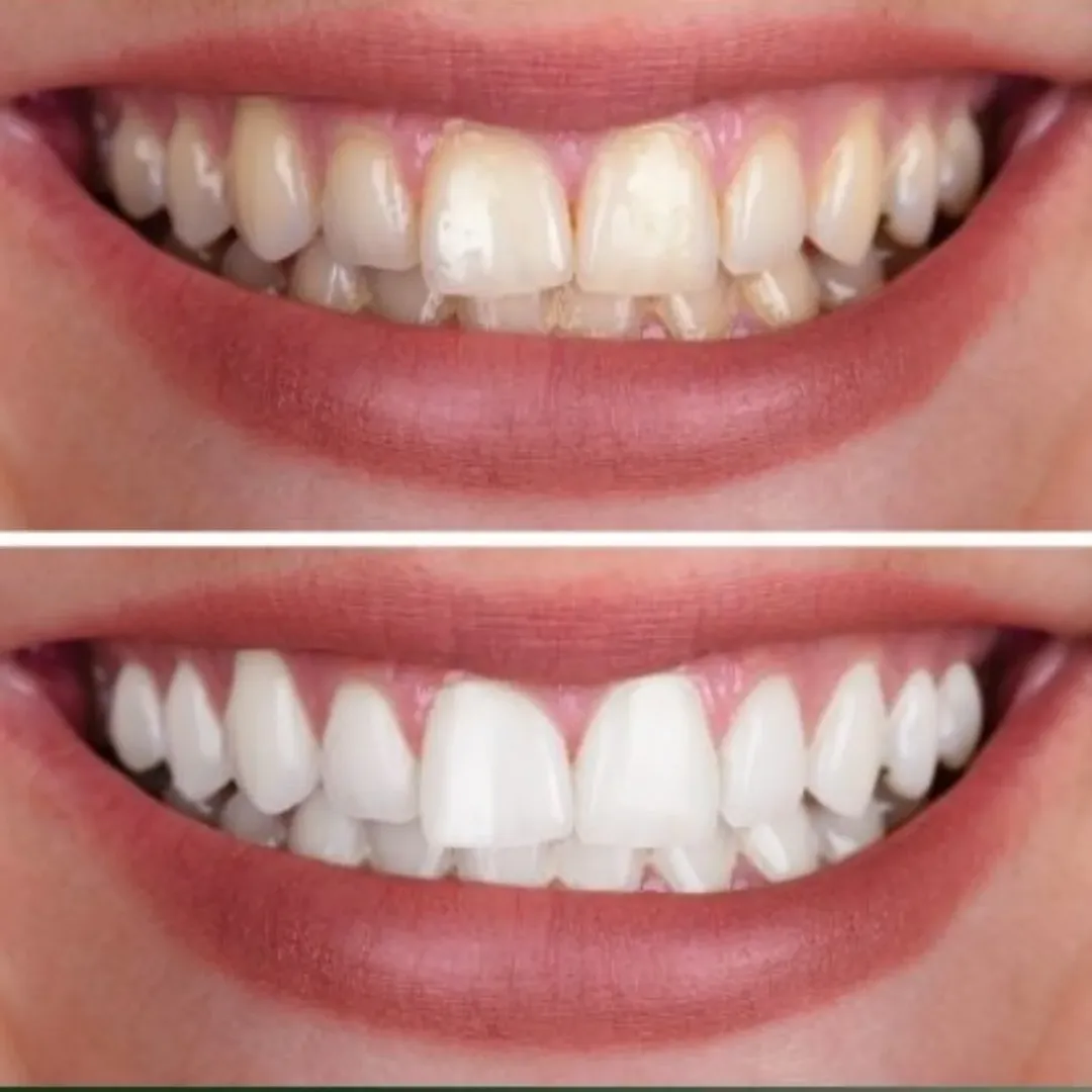 Reabilitação com Implantes (antes e depois)